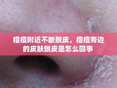 痘痘附近不断脱皮,痘痘旁边的皮肤蜕皮是怎么回事
